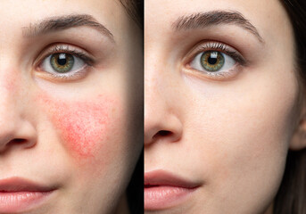 collage comparing healthy skin and face suffering rosacea, visible blood vessels and capillaries. ca