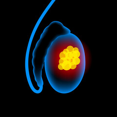 Poster - Prostate cancer concept