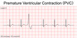 Electrocardiogram show ventricular fibrillation (VF) pattern. Cardiac fibrillation. Heart beat. CPR. ECG. EKG. Vita