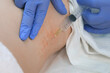Doctor makes injection of ozone gas in patient woman on side of body on ozone therapy, closeup view. Treatment, cure and remove of skin tags and stretches. Correction of skin after pregnancy.