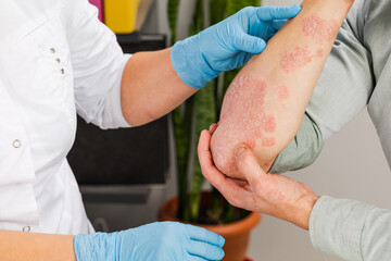 Wall Mural - A dermatologist wearing gloves examines the skin of a sick patient. Examination and diagnosis of skin diseases-allergies, psoriasis, eczema, dermatitis