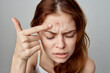 © SHOTPRIME STUDIO - woman squeezes pimple on her forehead skin problems cosmetology
