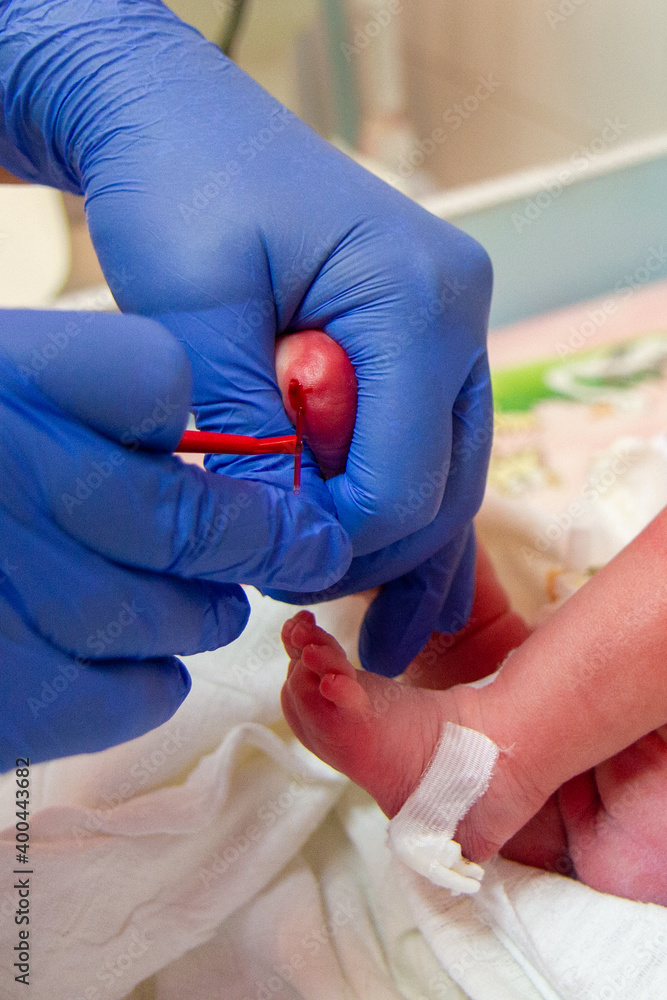 Neonatal Testing Newborn blood spot or heel prick test (the Guthrie test). A ...