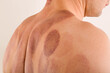 © Eskymaks - Cupping therapy marks on black