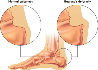 Wall Mural - Medical illustration shows the comparison between a normal calcaneus and one affected by Haglund's deformity, with annotations.