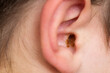Earwax in the dirty ear of a child. Hole ear of human, wax on hair and skin of ear