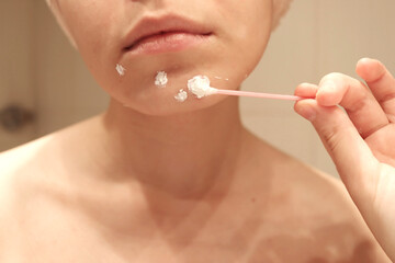 The woman applied the ointment to the pimples. Home care for problem skin. Acne treatment