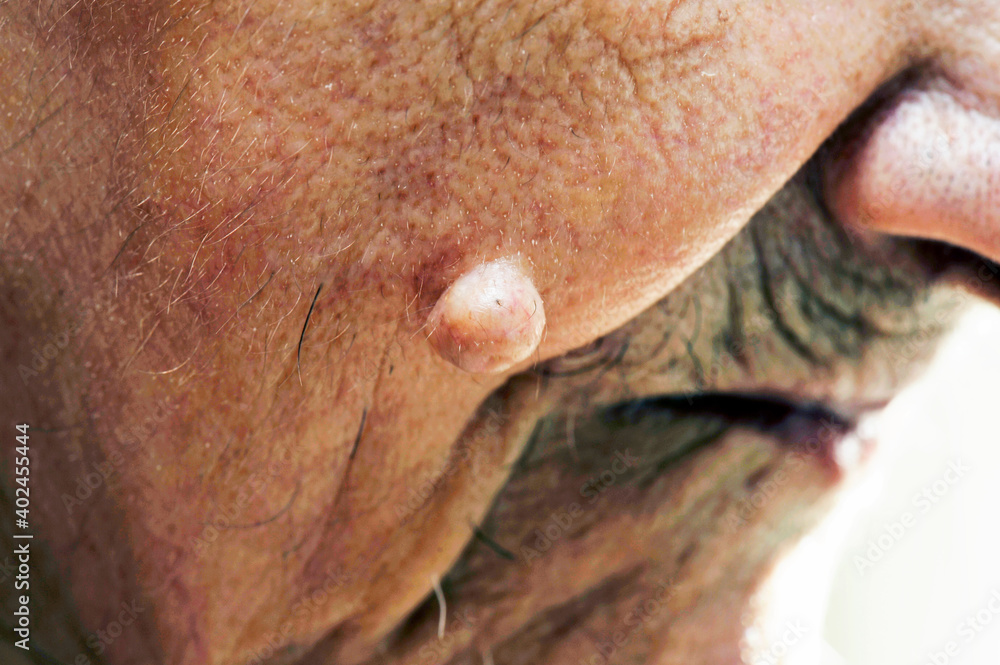 Dermatofibroma Pictures On Face