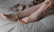 Woman putting on compression stockings on swollen feet affected by lymphedema condition