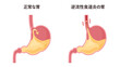 逆流性食道炎の胃と胃酸のイラスト