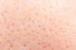 Macro shot of blackheads on facial skin, clogged pores