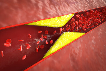 atherosclerosis with plaque in vessel