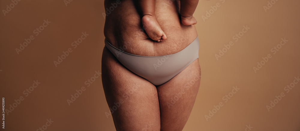 Postpartum belly after baby - obrazy, fototapety, plakaty 