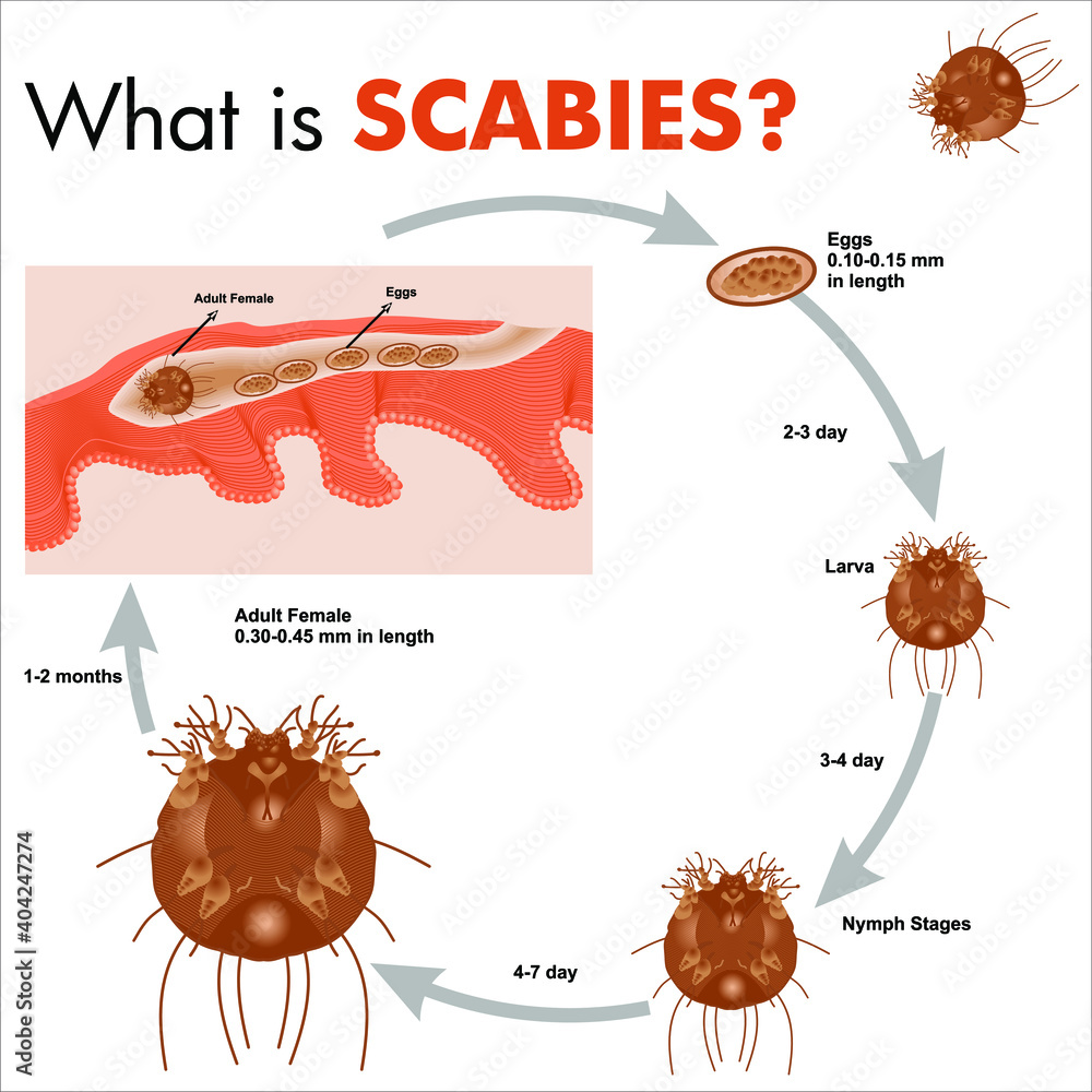 Scabies, What is Scabies Stock Vector | Adobe Stock