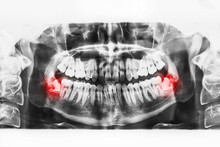 X-ray Image Of Oral Cavity With Growing Lower Wisdom Teeth On White Background