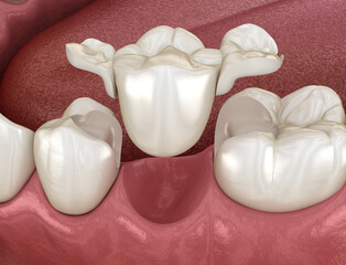 Maryland bridge made from ceramic, premolar tooth recovery. Medically accurate 3D illustration of dental concept