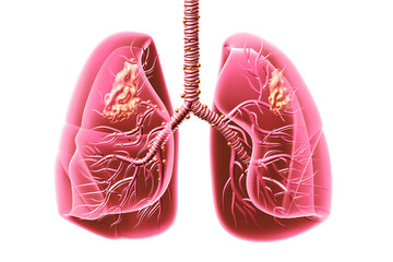 Wall Mural - Lung cancer. lung disease