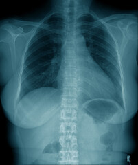 Sticker - chest x-ray image in blue tone