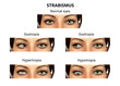 © Dr_Microbe - Strabismus, eyes deviation, illustration