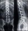 x ray image of a spinal