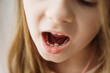 Adult permanent teeth coming in front of the child's baby teeth: shark teeth. Little girl's open mouth.