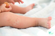 © smile35 - A small child with a red rash on the leg sits on the bed. Children is allergies.