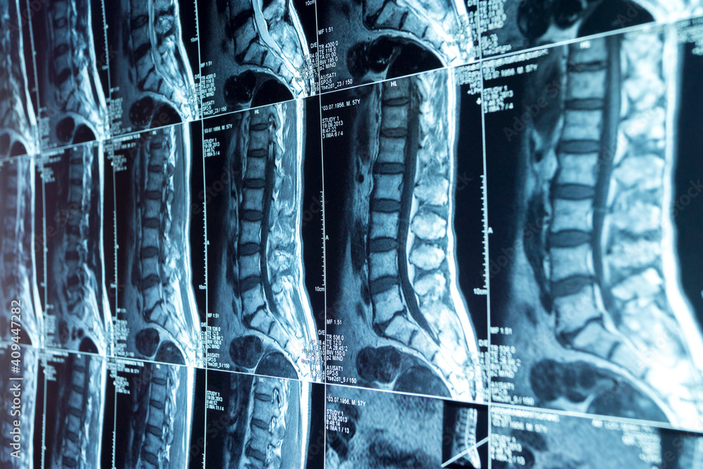MRI scans of the lumbosacral spine Stock Photo | Adobe Stock