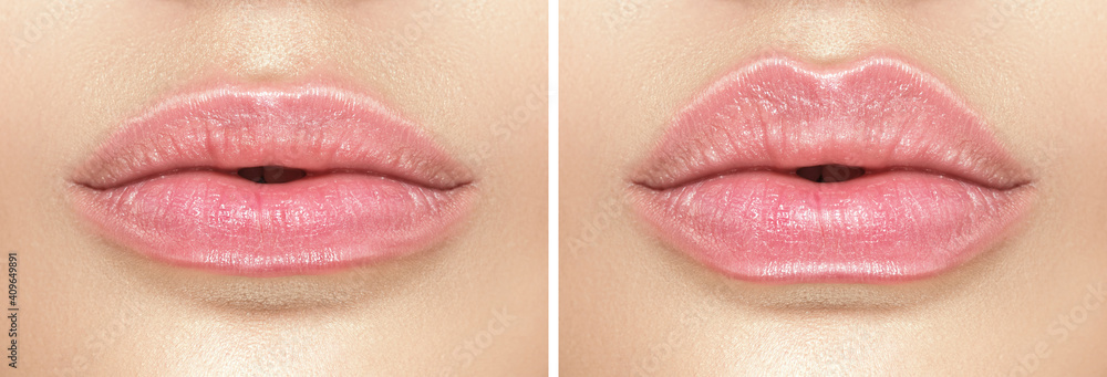 Before and after lip filler injections. Fillers. Lip augmentation Beautiful Perfect Lips. Sexy Mouth close-up. Beauty young woman Lips. Plastic surgery. Close up - obrazy, fototapety, plakaty 