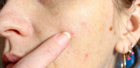 The skin of an older woman with pimples and enlarged pores. Skin care.