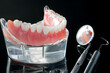 Teeth model showing an implant crown bridge model/ dental demonstration teeth study teach model.