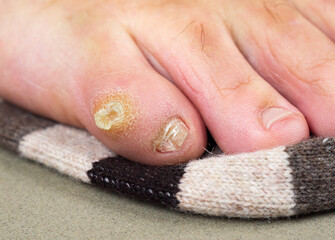 Big dry callus and misshapen nail on the little toe of a man's foot. Consequences of wearing uncomfortable, tight shoes.