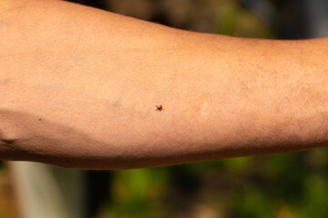 Ixodid bloodsucking tick on the hand. Walk in the park in spring. Dangerous insects