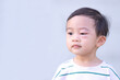© Teerawat - Asian baby boy is bitten by mosquitoes, allergy to insect bites unrecognizable swollen eye, Dermatitis problem of rash.Blank space for text.