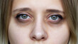 © Марина Демешко - Cropped shot of a young female face. Green eyes with dark circles under the eyes and with red capillaries. Bruises under the eyes are caused by insomnia, fatigue, nervousness, lack of sleep and stress