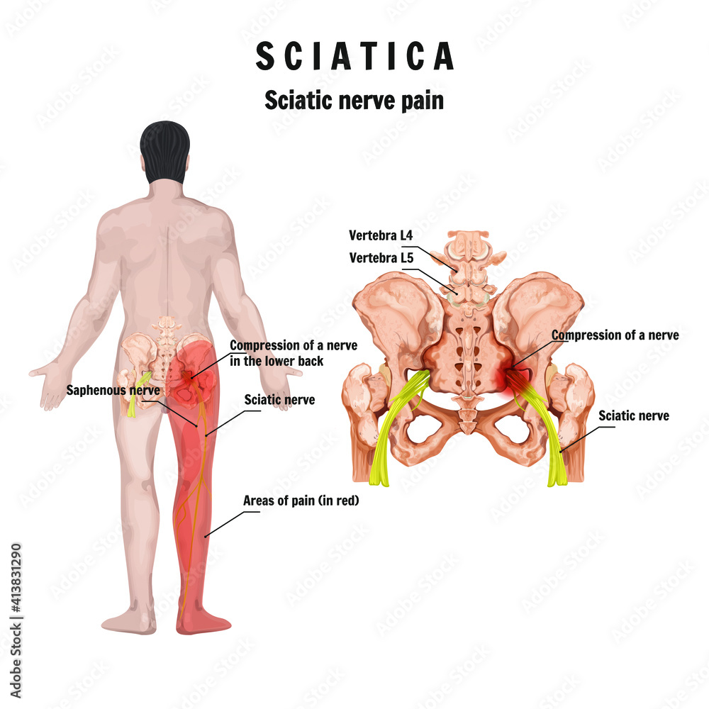 Sciatica – symptoms and causes, medical illustration of sciatic nerve ...