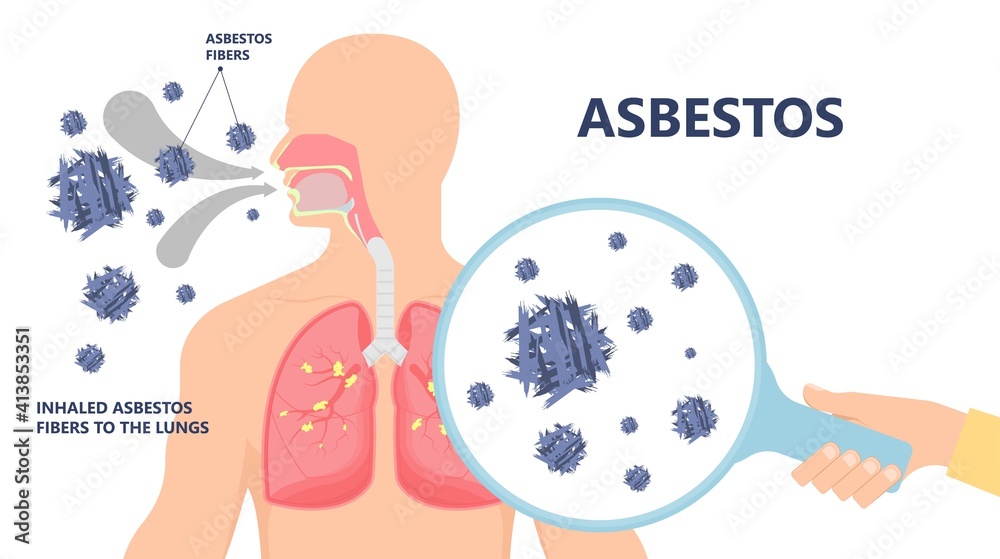 Asbestos Breath Chest Pain Testes Ascites Hydrocele Scrotum Swollen