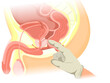 Digital rectal examination vector illustration. Illustration of the finger eximining the prostate