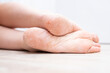 The dry skin on the feet is cracked. Treatment concept with moisturizing creams and exfoliation for healing wounds and pain when walking. Dehydrated skin on the heels of female feet
