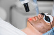 © salomonus_ - Close-up of laser peeling of facial skin. Girl doing carbon pilling procedure