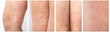 Panel Collage about acute atopic dermatitis on the legs of a child is a dermatological disease of the skin. Large, red, inflamed, scaly rash on the legs. Legs of a teenager with severe atopic eczema.