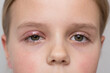 Selective focus, concept. Girl 10 years old close up portrait. One eye has barley. Grey background.