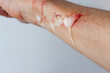 Treatment of a bleeding wound on the arm. Decontamination of the wound. Applying a bandage to a fresh wound.