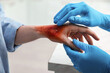 Doctor examining terrible patient's burn of hand indoors, closeup