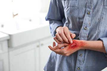 Canvas Print - Woman with burn on her hand indoors, closeup. Space for text