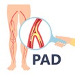 Graft artery PAD flow legs pain fatty treat hips Calf toes feet High heart ABI foot test Ankle clot injury arms stent veins Sores index attack venous ulcers blood limbs