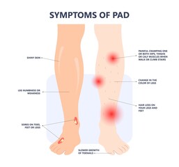 Graft artery PAD flow legs pain fatty treat hips Calf toes feet High heart ABI foot test Ankle clot injury arms stent veins Sores index attack venous ulcers blood limbs