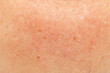 pigmentation on the skin in the neck and chest area as a background