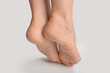 © Celt Studio - foot with dry skin on heel and sole. women female feet with rough cracked skin isolated on gray background, close up, copyspace