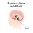 Brainstem glioma in childhood. Brain cancer, tumor with explanations.
