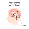 © maniki - Astrocytoma in childhood. Brain cancer, tumor with explanations.